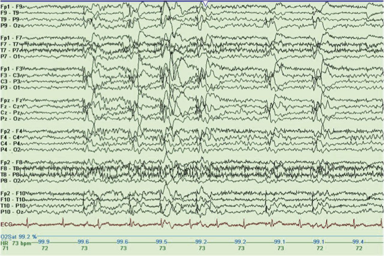 Reading Epilepsy, ovvero l'Epilessia da Lettura