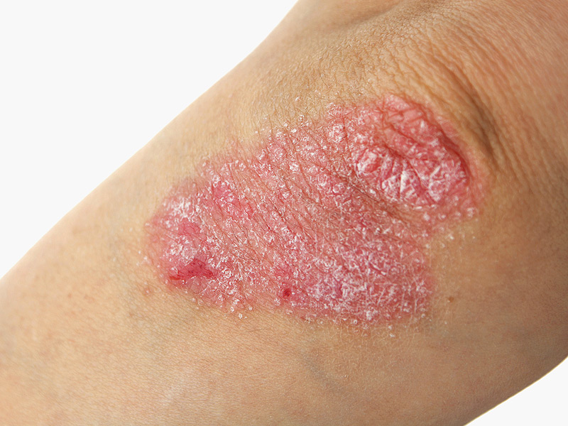 Psoriasi? Ecco come porvi rimedio in modo naturale